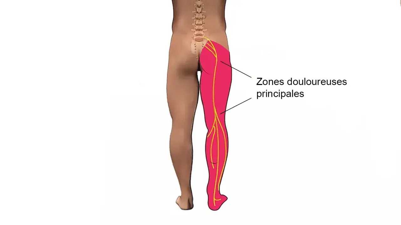 Schéma montrant les zones douloureuses principales d'une jambe, utiles pour 7 exercices pour la cruralgie.
