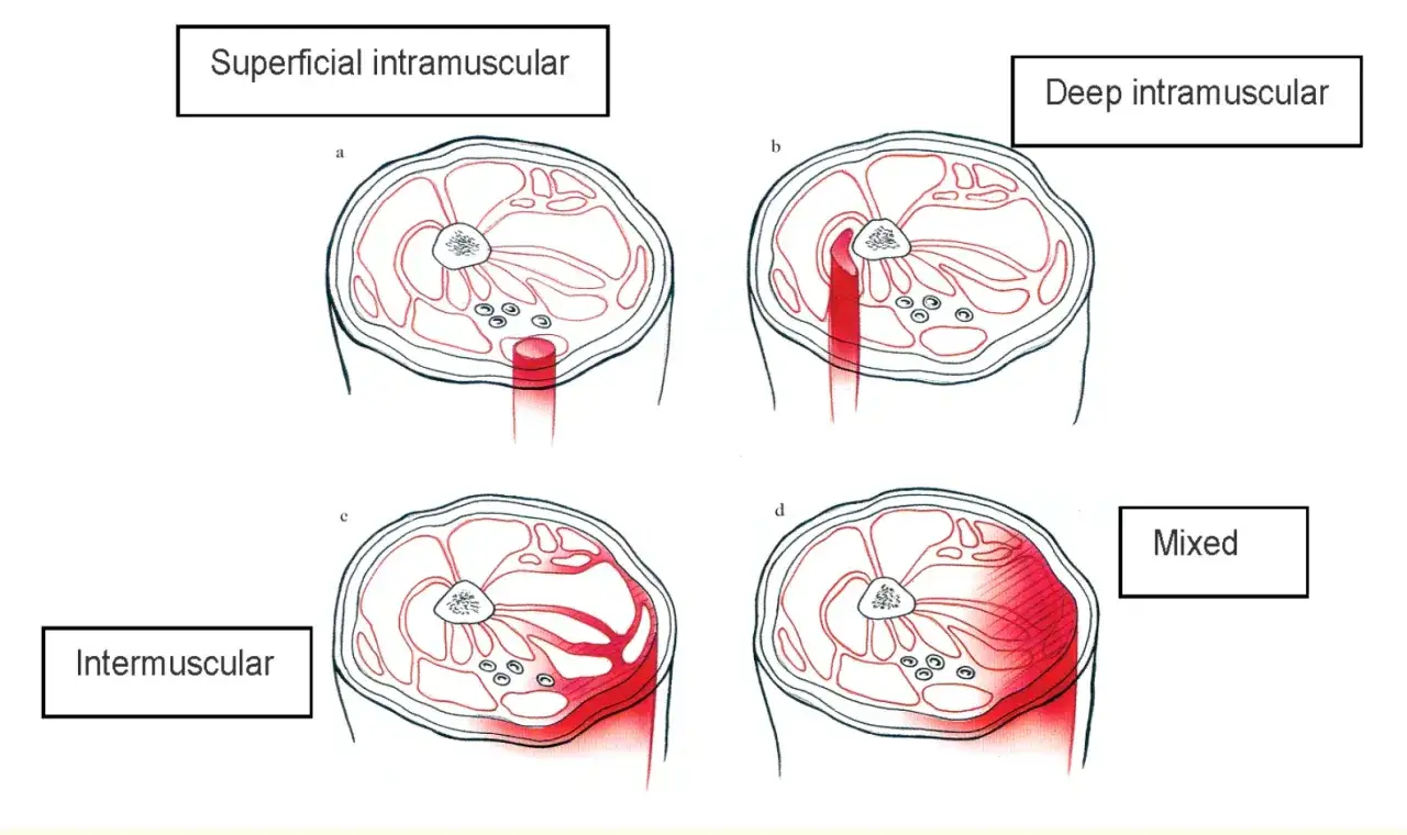 Illustrations montrant un claquage mollet avec h&eacute;matome, superficiel, profond, intermusculaire et mixte.
