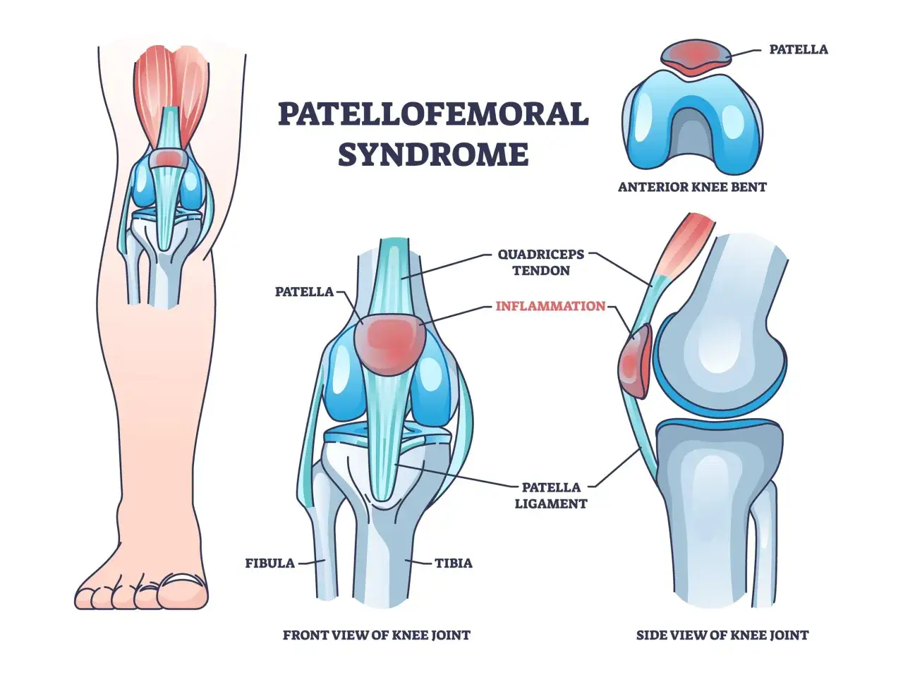 Illustration du syndrome fémoro-patellaire, montrant l'inflammation du genou, une cause fréquente de douleur genou course à pied.