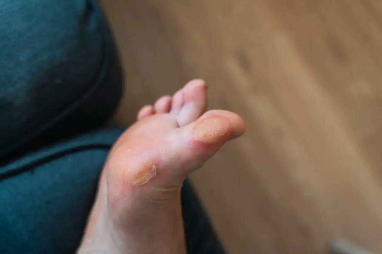 Pied avec ampoules sur le dessus et la plante. Combien de temps dure une ampoule au pied ? Cela dépend de la cause et du soin apporté.