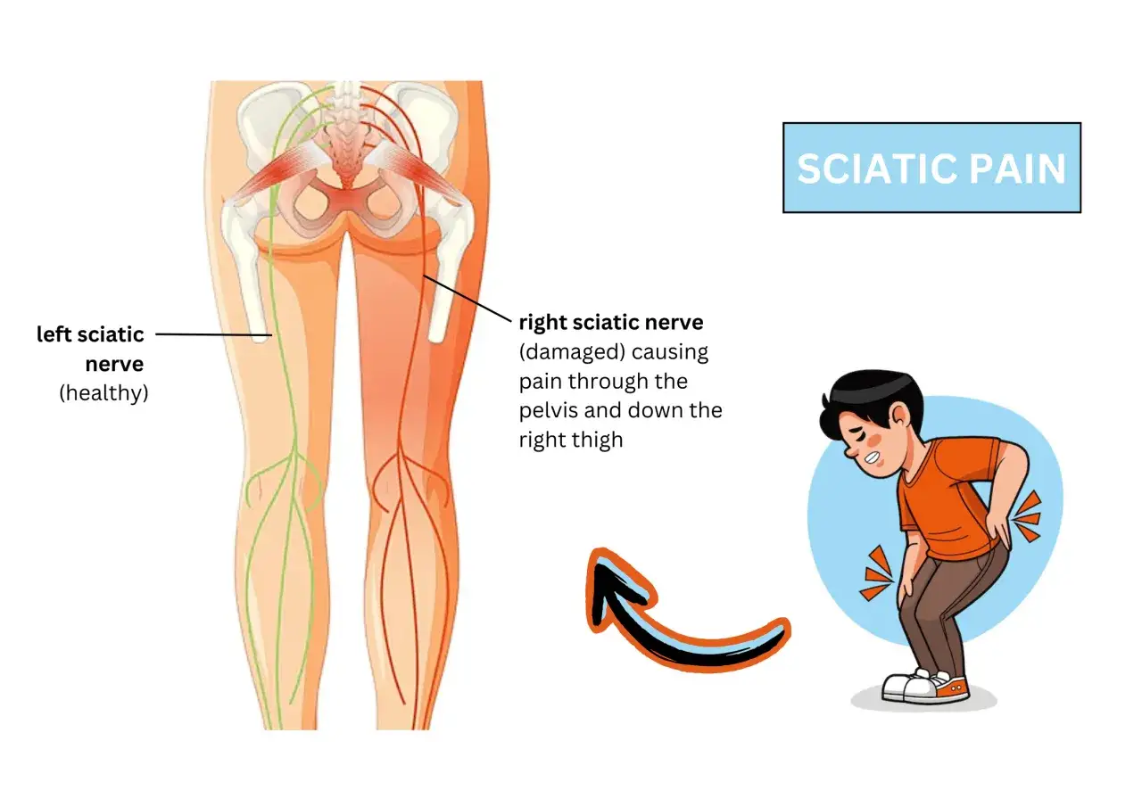 Douleur sciatique : le nerf sciatique droit endommagé cause une douleur au mollet. Illustration du traitement.